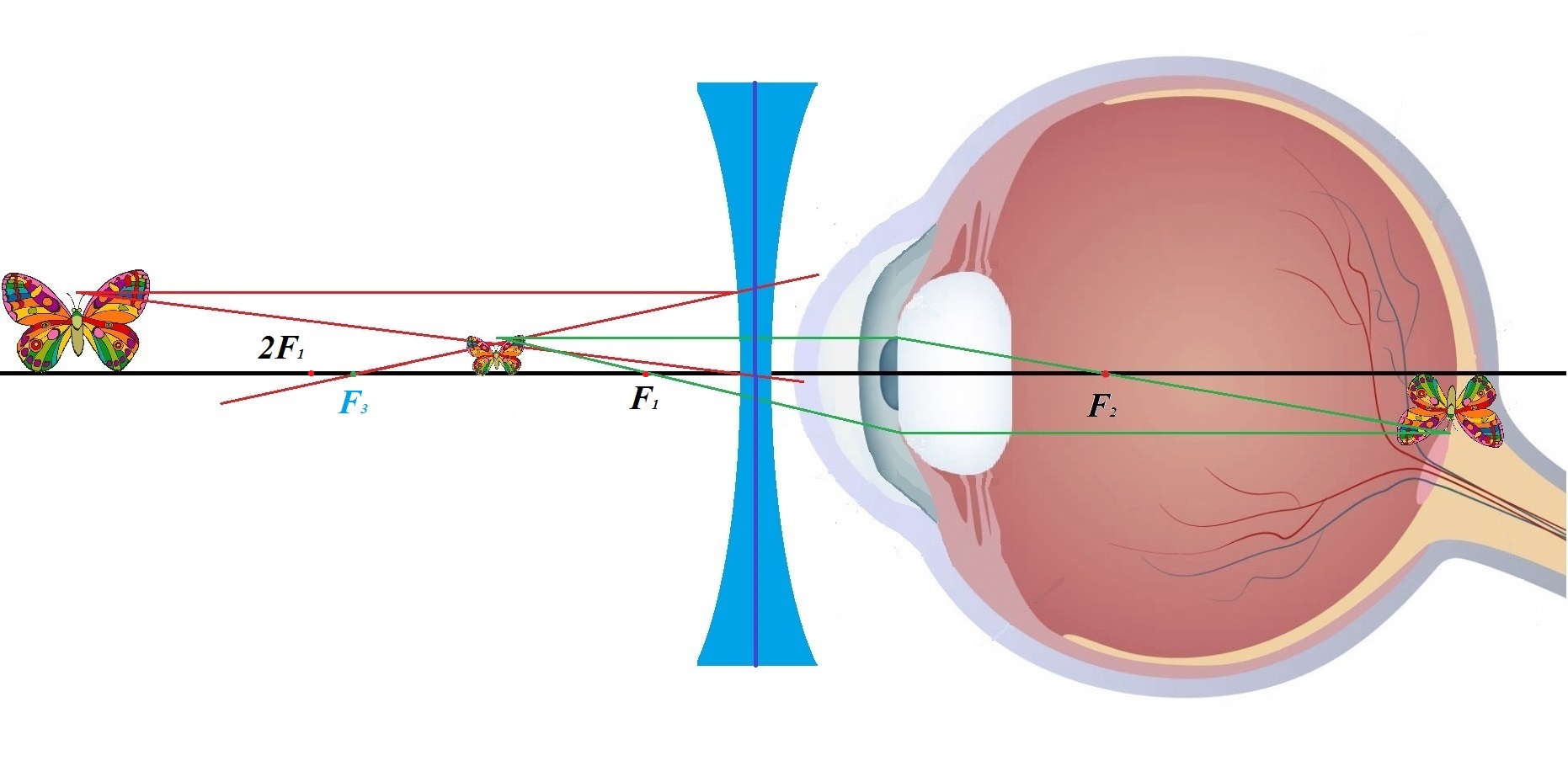 Близорукость Картинка Глаза – Telegraph